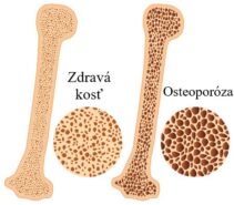 osteoporosis-bone-80